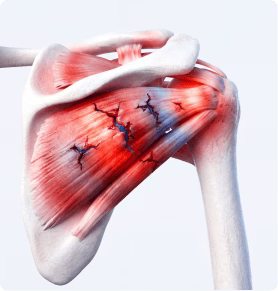 Overworked Shoulder Tendons